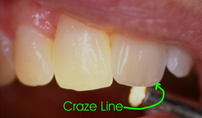 What Are Craze Lines?